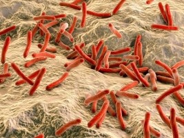 Haiti - Health : First case of leprosy in Chile diagnosed in a Haitian patient