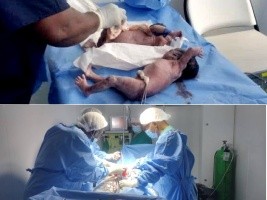 iciHaïti - Caravane chirurgicale : Une adolescente de 16 ans donne naissance a des jumeaux
