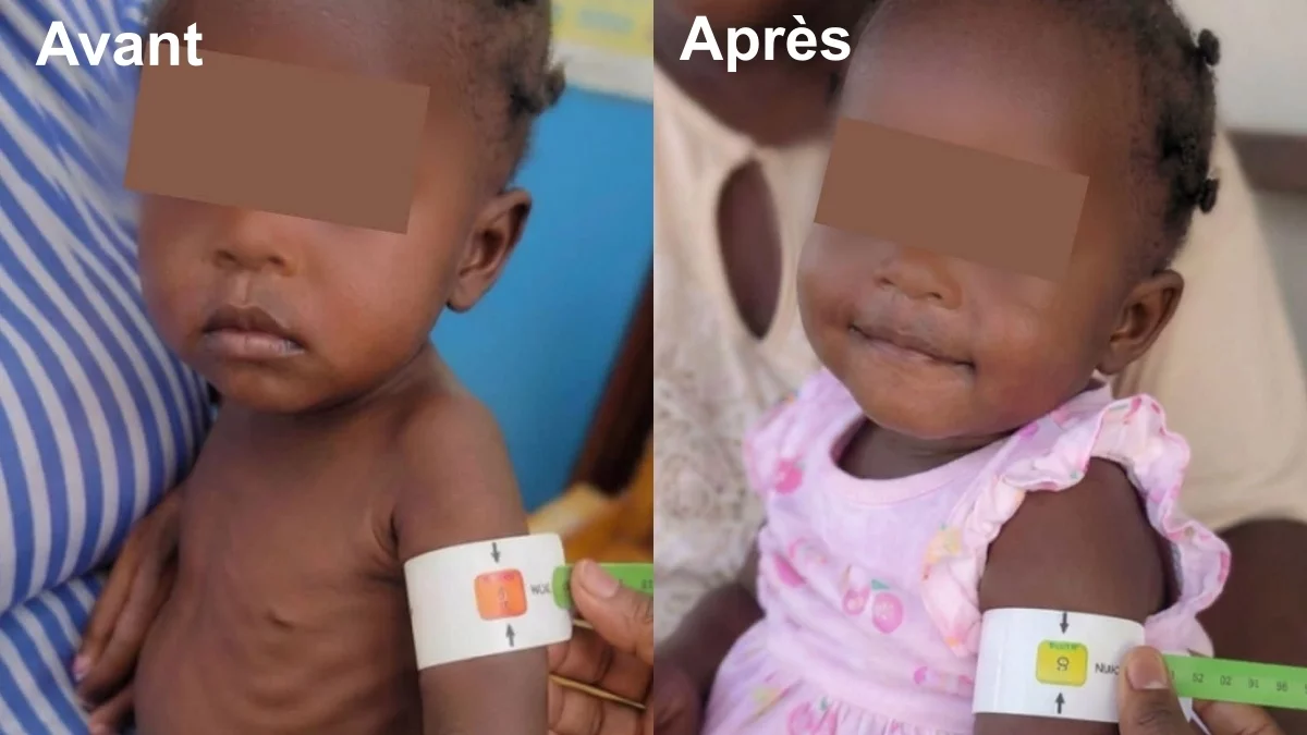 iciHaïti - Crise : Plus de 5,000 enfants traités pour malnutrition aiguë