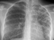 iciHaiti - Health : 16,234 cases of tuberculosis in the country