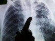 iciHaiti - Health : Zero tuberculosis target by 2030
