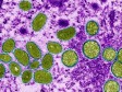 Haïti - FLASH : Un cas suspect de variole du singe découvert dans l'Artibonite